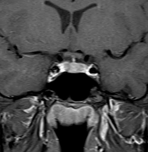 MRI T1 Fat Saturated Post Contrast Gadolinium Sequence Physics And