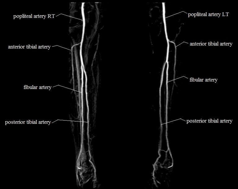 Lower Legs Arteries Anatomy MRA Lower Legs Arteries Anatomy