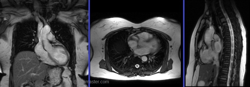 Cardiac MRI Flow Quantification Protocols Planning And Techniques