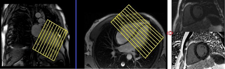 Cardiac Mri Protocols Planning And Techniques Positioning For