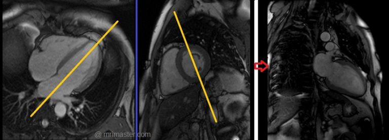 MRI Cardiac T1 Mapping T2 Mapping T2 Mapping