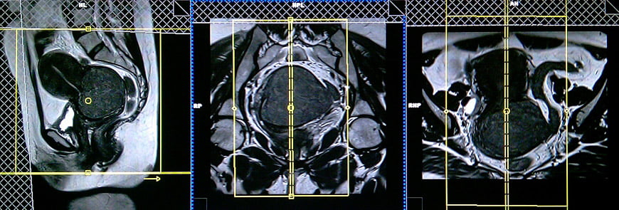 Mri Female Pelvis Planning For Different Types Of Cervix Cancers