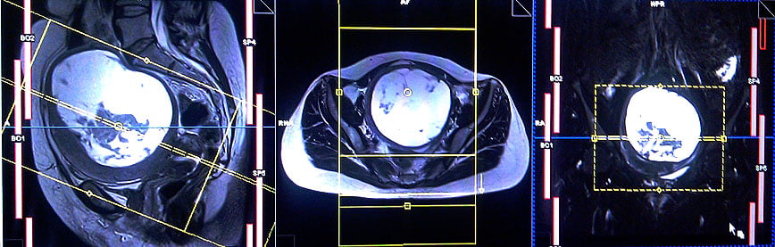 MRI Female Pelvis Planning For Different Types Of Endometrial Cancers