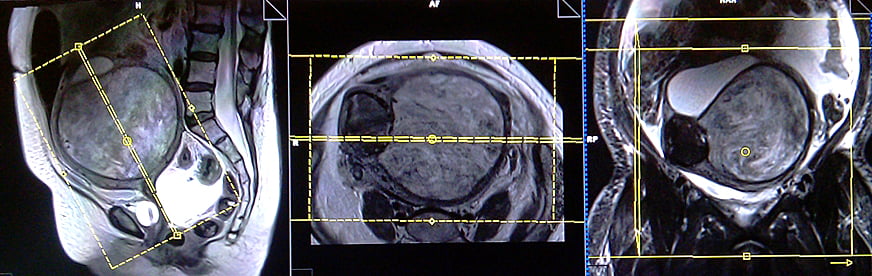 MRI Female Pelvis Planning For Different Types Of Endometrial Cancers