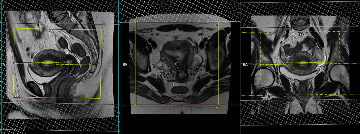 Gynaecologic Mri Pelvis Uterus Cervix And Adnexal Protocols And