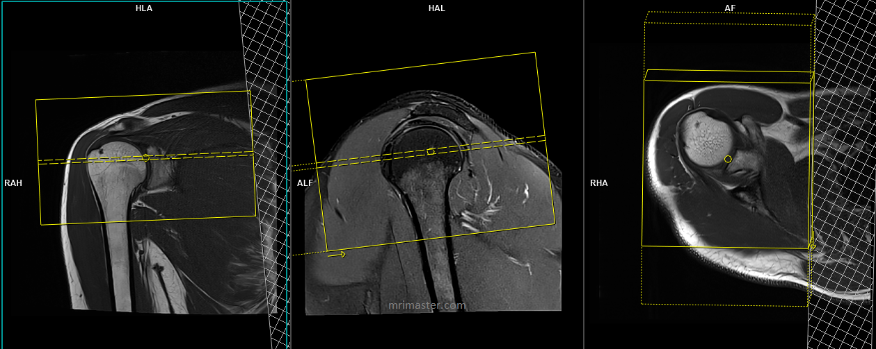 Shoulder Mri Planning Mri Shoulder Protocols Indications For Mri