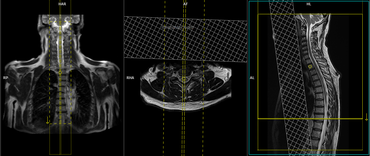 MRI Whole Spine MRI Whole Spine Protocol And Planning