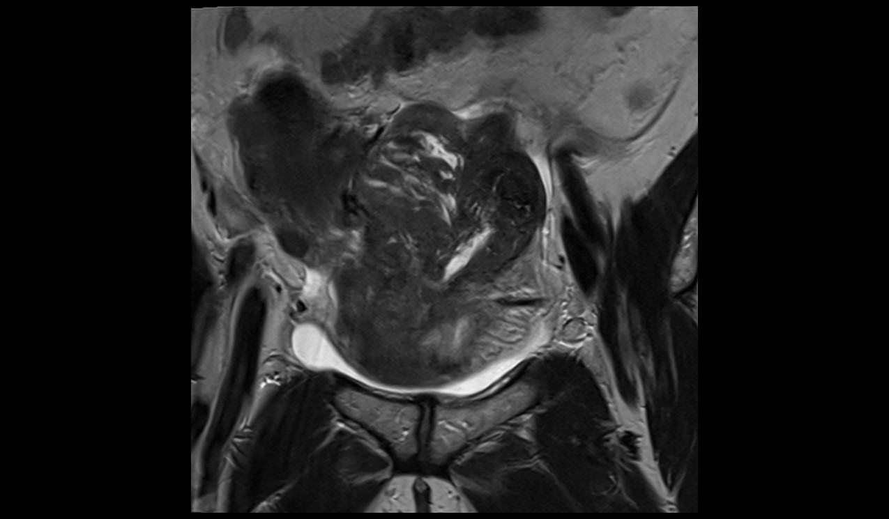 Mri Gynae Fibroids T Tse Coronal Images