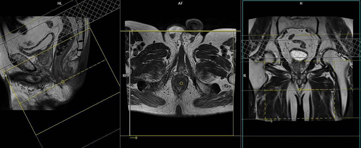 Anal Fistula Mri Perianal Fistula With Contrast Protocol And Planning