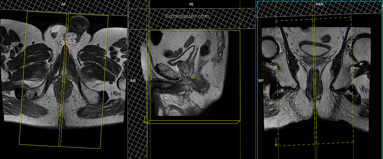 Anal Fistula Mri Perianal Fistula With Contrast Protocol And Planning