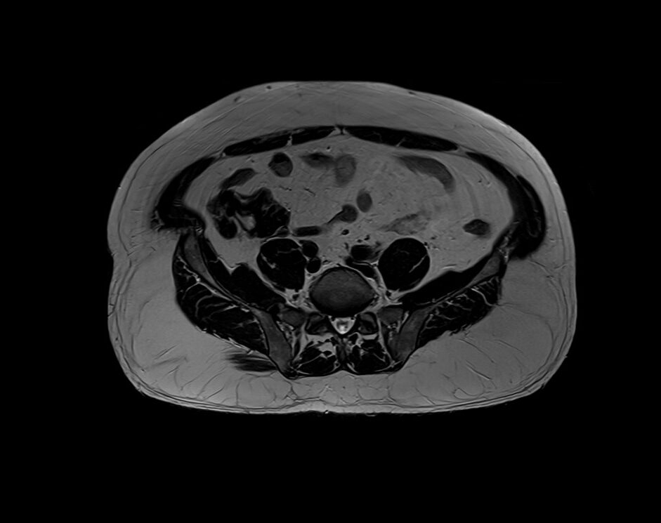 T Mri T Weighted Mri Sequence Physics And Image Appearance