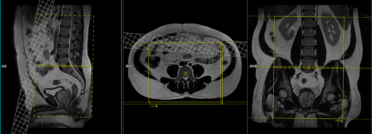 Lumbar Plexus Mri Protocol Hot Sex Picture