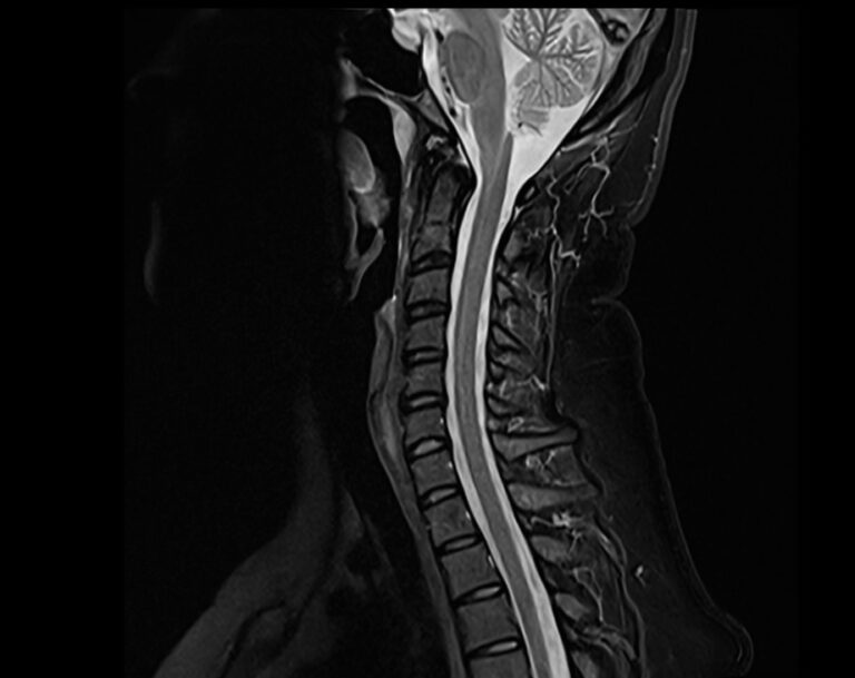 Stir Mri Sequence Physics Pathology And Image Appearance