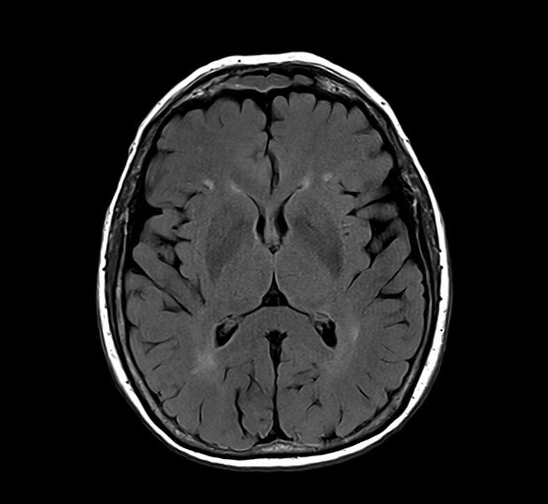 FLAIR MRI FLAIR MRI Sequence Physics Image And Pathology Appearance