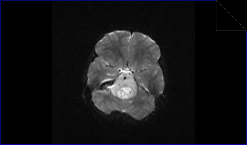 Pontine Glioma Diffuse Intrinsic Pontine Glioma DIPG