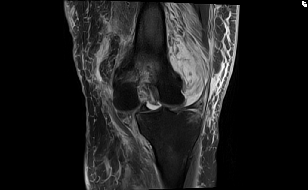 Knee Dislocation MRI Radiology Article On Knee Dislocation