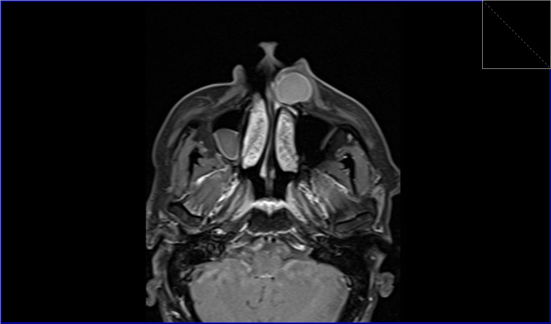 Epidermoid Cyst Mri Radiology Article On Mri Of Epidermoid Cysts