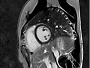 Phase Sensitive Inversion Recovery PSIR MRI PSIR Cardiac MRI