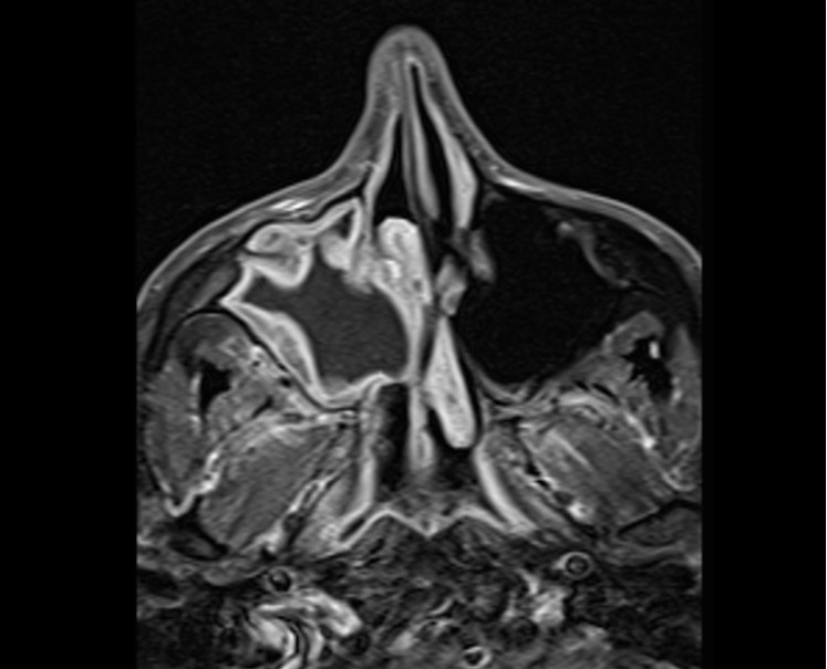 Antrochoanal Polyp Mri Radiology Article On Antrochoanal Polyp