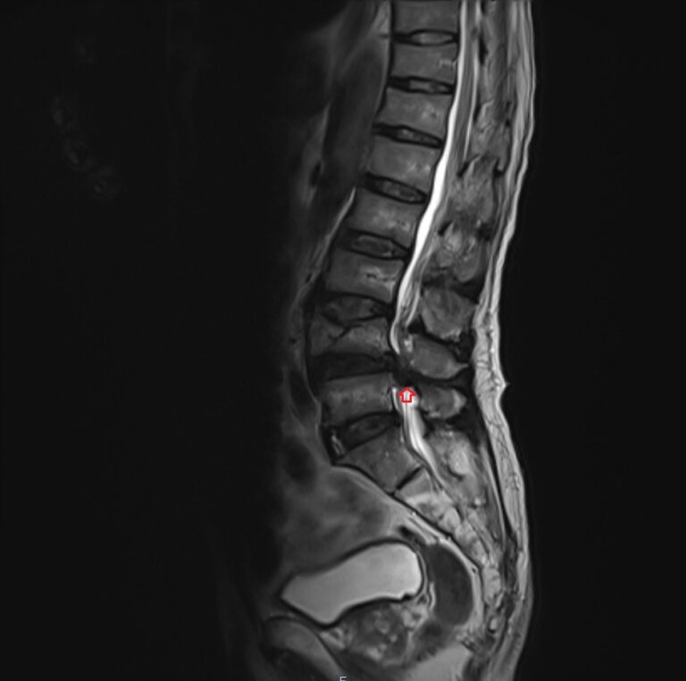 Mri Cauda Equina Syndrome Radiology Article On Cauda Equina Syndrome