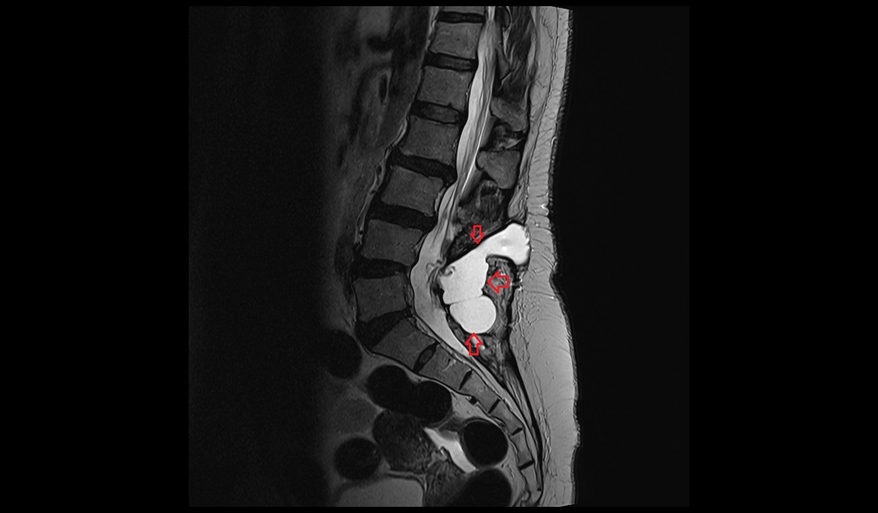 Csf Leak Mri Radiology Article On Csf Leak