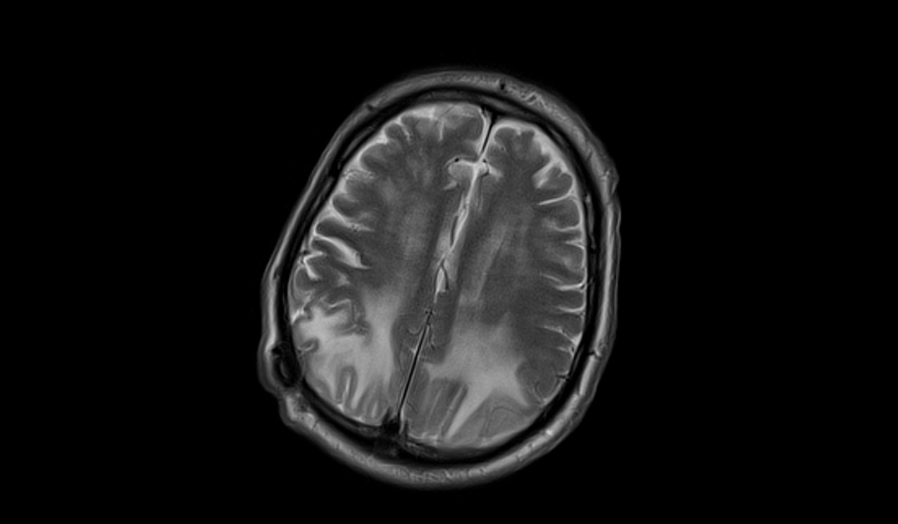 Posterior Reversible Encephalopathy Syndrome Pres Radiology Article