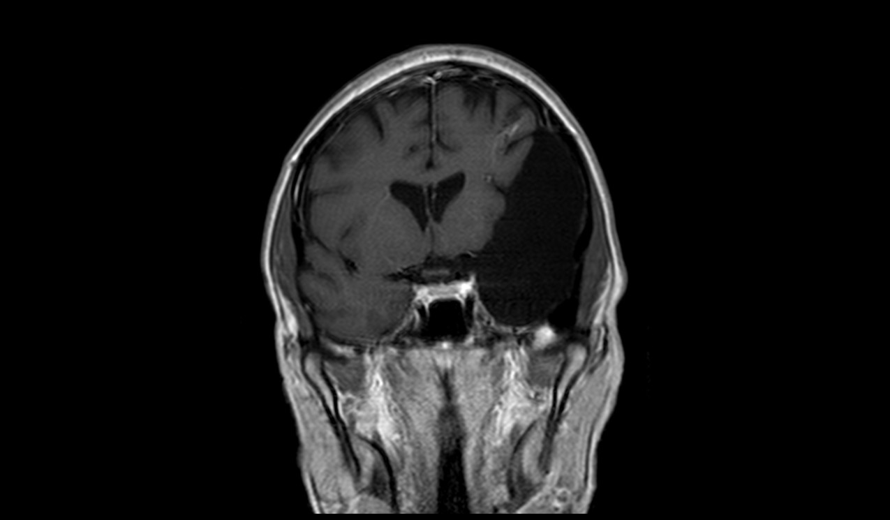 Arachnoid Cyst MRI Radiology Article On Arachnoid Cyst