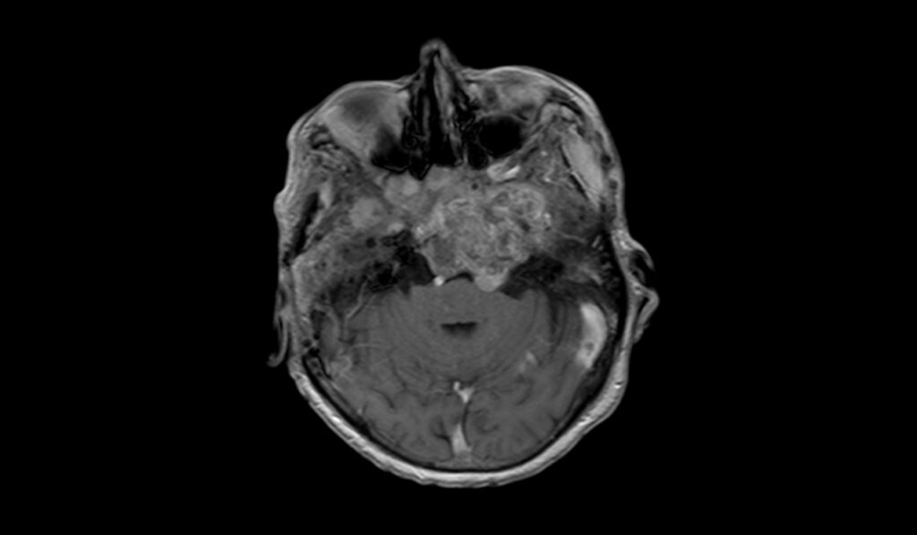 Clival Chordoma Mri Radiology Article On Clival Chordoma