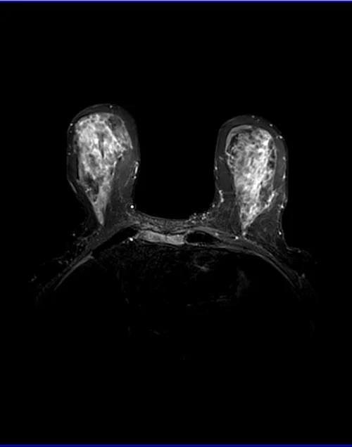 STIR axial sequence used in breast imaging