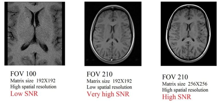 Signal-to-Noise Ratio (SNR) in MRI | Factors affecting SNR