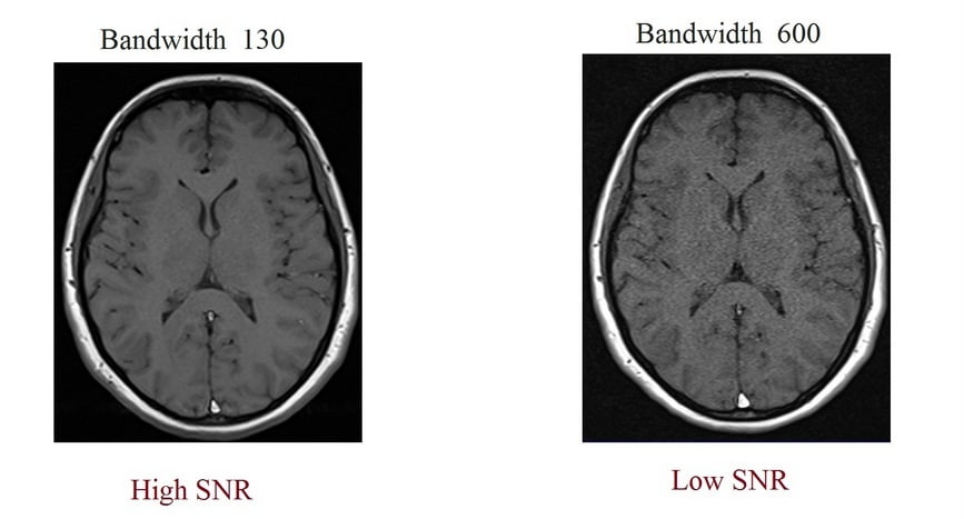 High and low bandwidth MRI image