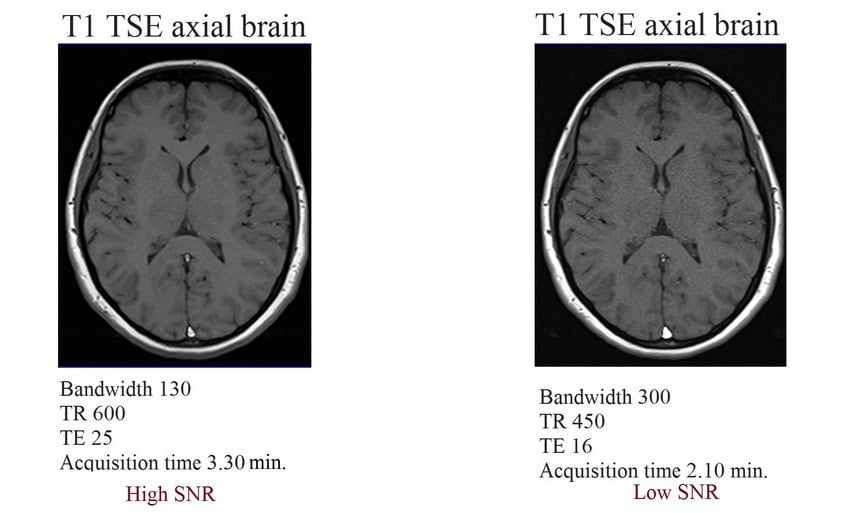 MRI Practical applications of high Receiver bandwidth (rBW)