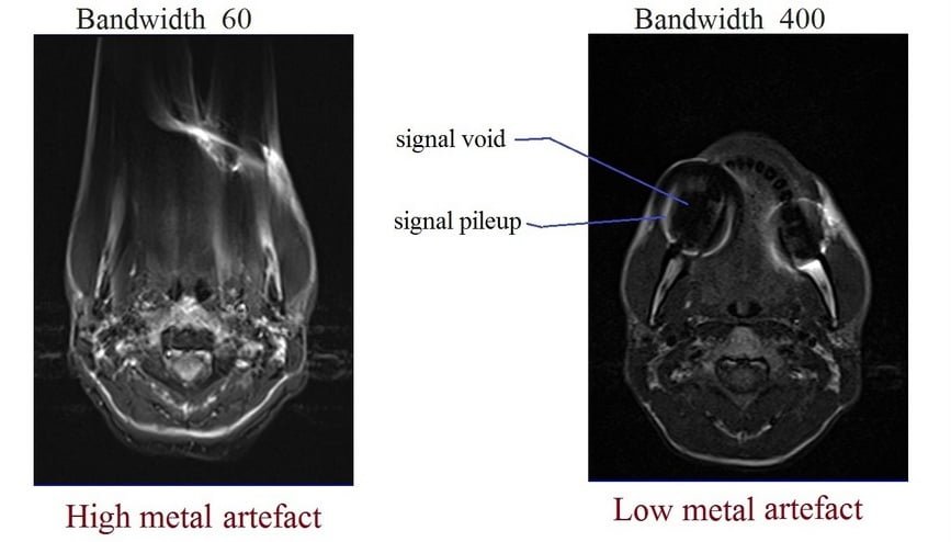 Narrow bandwidth - Questions and Answers ​in MRI