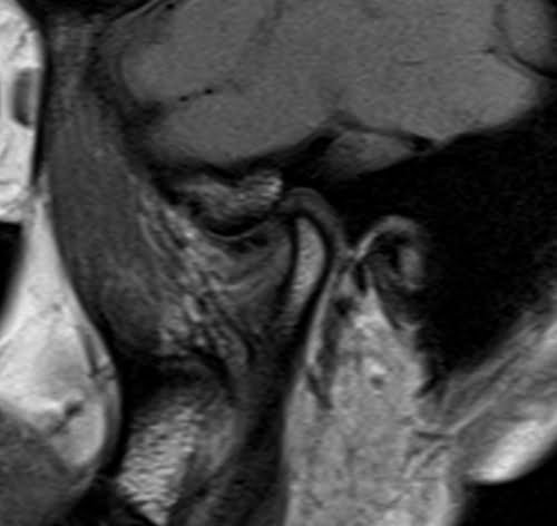 PD SAGITTAL SEQUENCE USED IN TMJS IMAGING