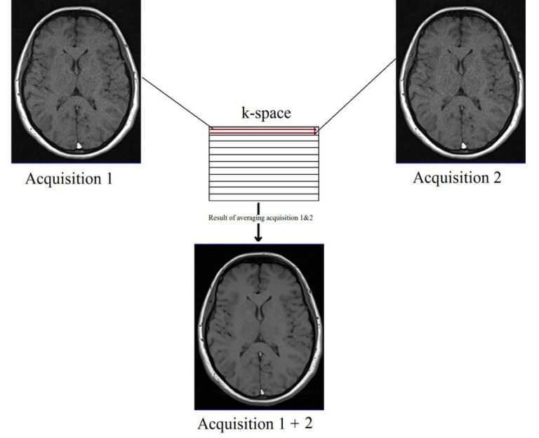 MRI NEX (averages) and image quality | Number of excitations(NEX) or ...