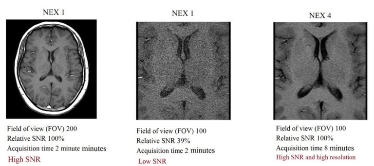 MRI NEX (averages) and image quality | Number of excitations(NEX) or ...