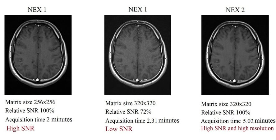 MRI NEX (averages) and image quality | Number of excitations(NEX) or ...