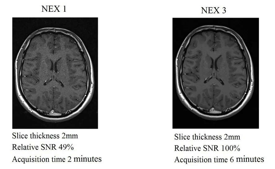 MRI NEX (averages) and image quality | Number of excitations(NEX 