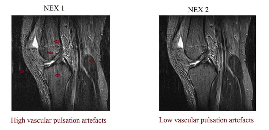 MRI NEX (averages) and image quality | Number of excitations(NEX) or ...