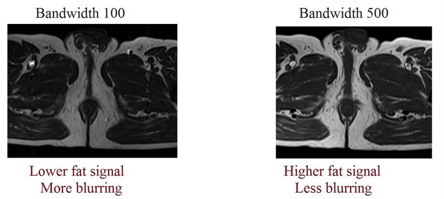 bandwidth and fat signal in MRI