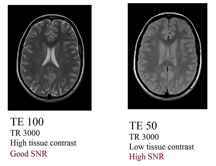 echo time (TE) and SNR relation in MRI
