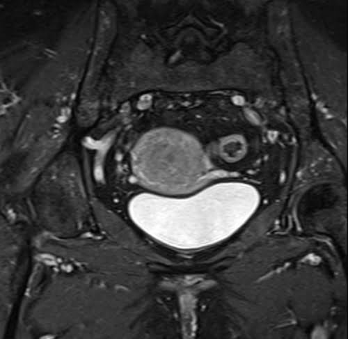 Mri T1 Fat Saturated Post Contrast Gadolinium Sequence Physics And Image Appearance