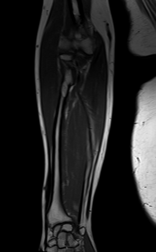 MRI fore arm coronal T1 image