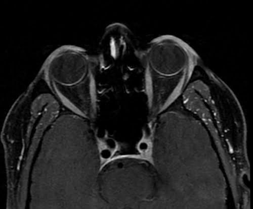 Mri T1 Fat Saturated Post Contrast Gadolinium Sequence Physics And Image Appearance