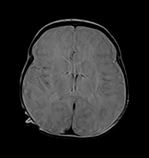 PD Axial sequence used in pediatric brain imaging