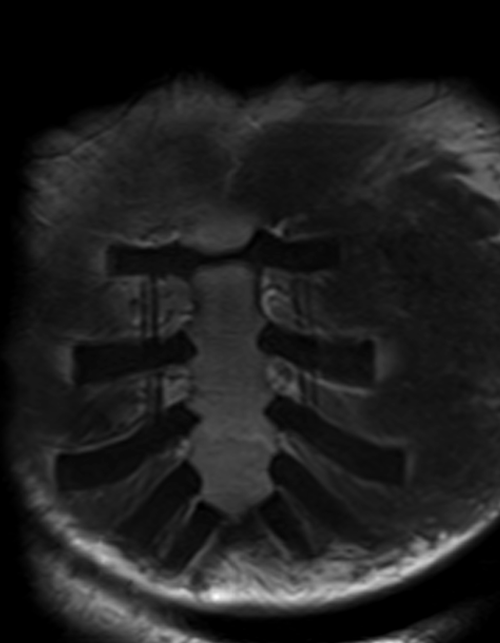 MRI sternum coronal T1 image