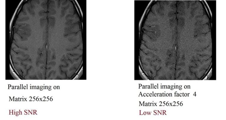 Signal-to-Noise Ratio (SNR) in MRI | Factors affecting SNR