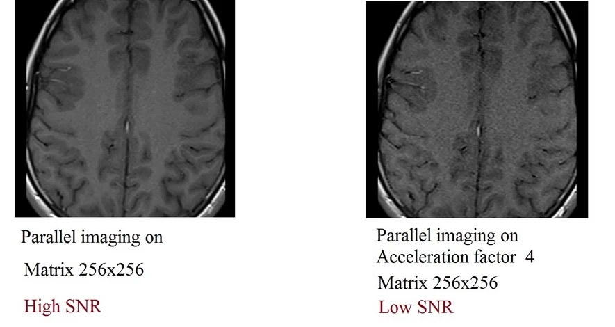 parallel imaging (Ipat) and SNR relation in MRI
