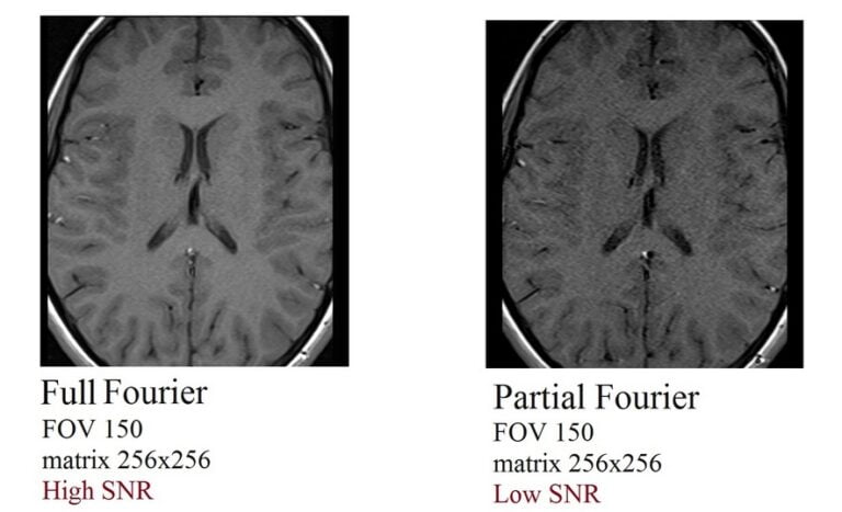 Signal-to-noise Ratio (snr) In Mri 