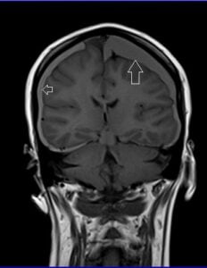 MRI Subdural haemorrhage images